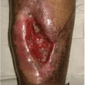 Wound Infections & Osteomyelitis